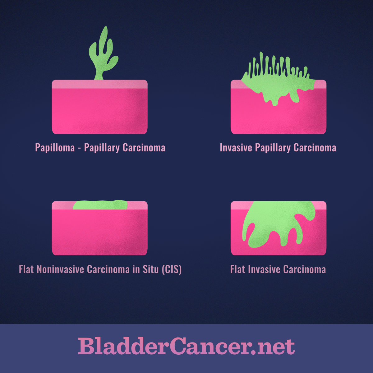 benign cancer of the bladder