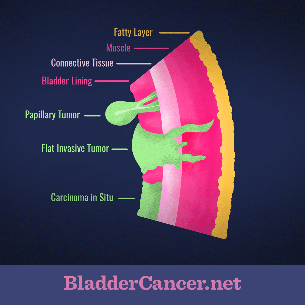 Layers in the bladder wall, from the inner lining to the fatty layer with different types of tumors.