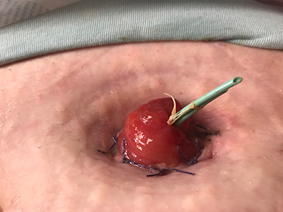 stoma resembling cherry