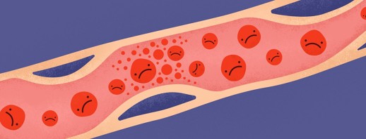 Bladder Cancer and Blood Clots (Thrombosis) image