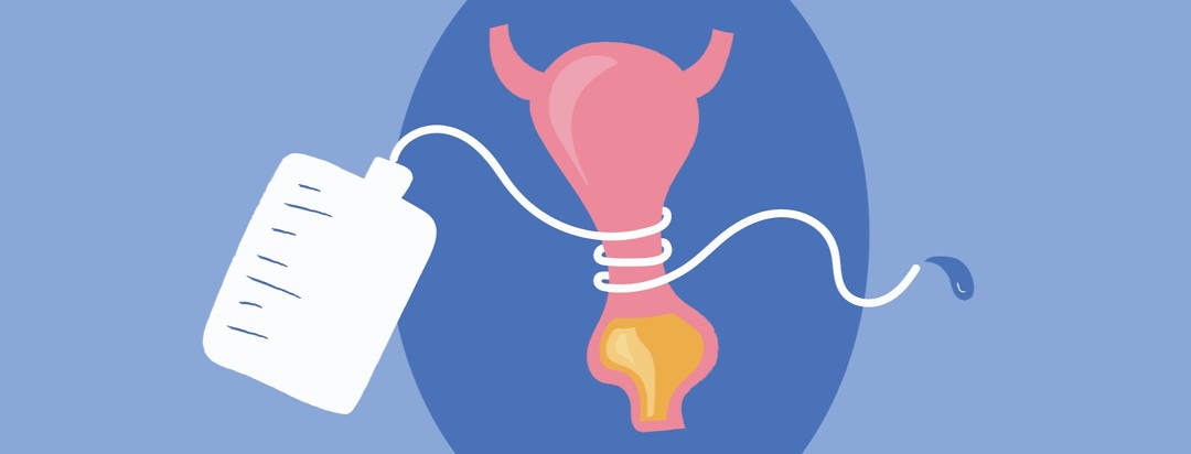 A bladder being squeezed by a BCG catheter