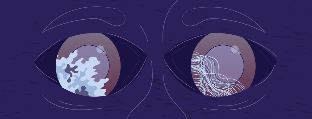 a pair of eyes with a reflection of two types of tumors in each of the eyes