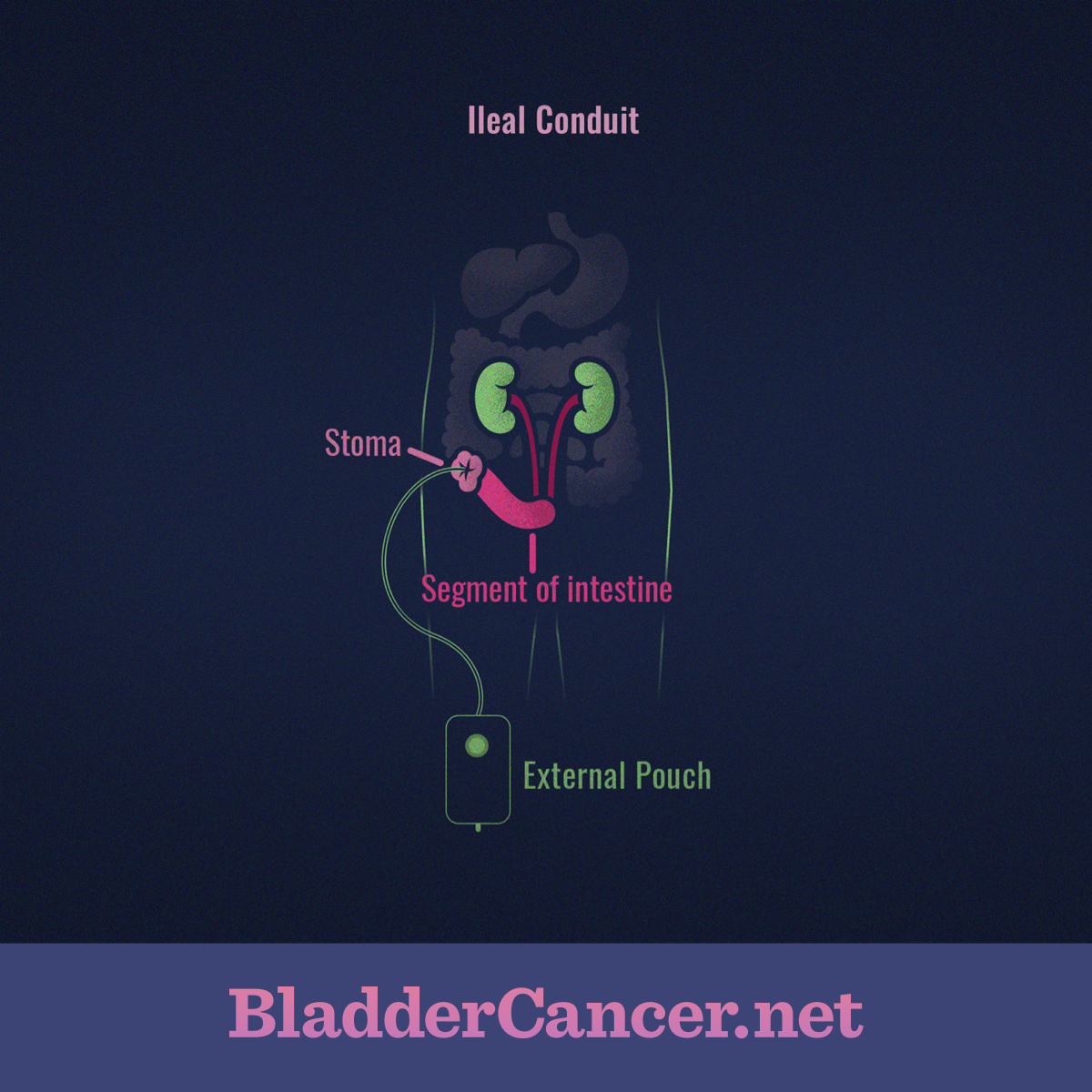 Diagram of an ileal conduit, demonstrating a segment of intestine leading to a stoma connected to an external pouch