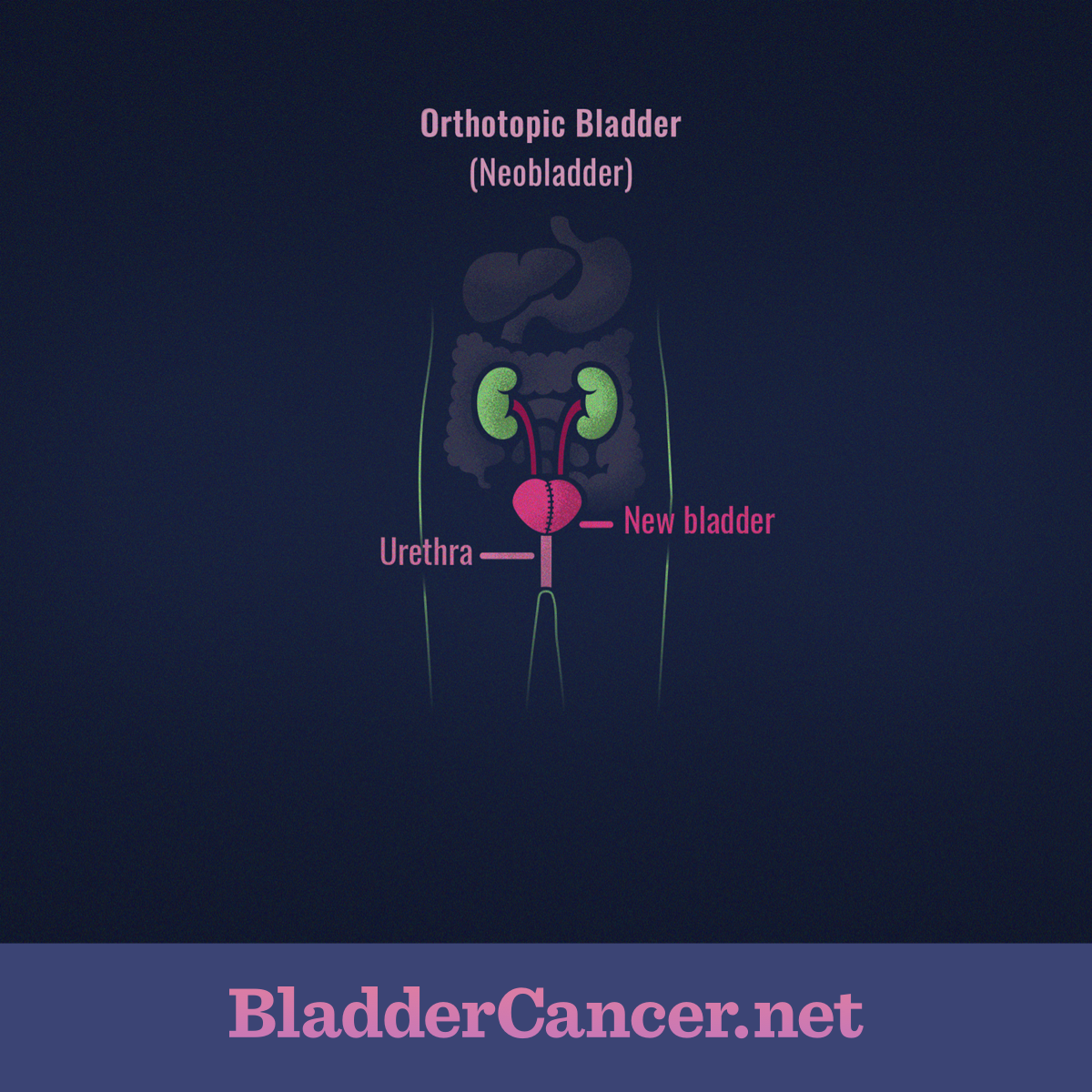 Diagram of an Orthotopic Bladder, or new bladder, connected to the urethra
